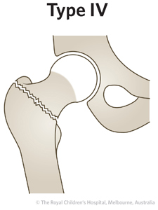 ED Section 1 FEMORAL NECK FRACTURE Type 4